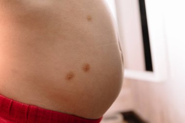 Yumuşakça Bulaşıcı Su Siğili olarak da bilinir. Çocuğun derisindeki karın bölgesinde tedavi edilmiş viral oluşumlar. Sağlık hizmetleri.