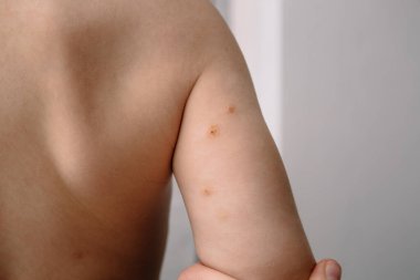 Yumuşakça Bulaşıcı Su Siğili olarak da bilinir. Bir çocuğun elinin derisinde tedavi edilmiş viral oluşumlar. Sağlık hizmetleri.