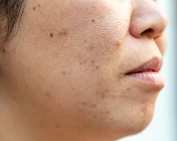 Problèmes de peau du visage est l'acné et les imperfections . — Photo