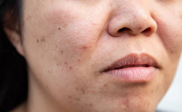 Problems facial skin is acne and blemishes.