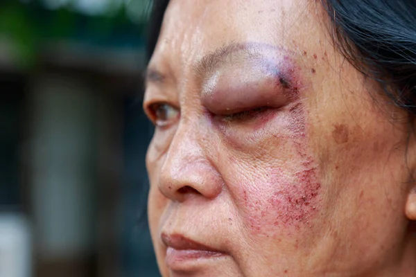 Elderly injury to the eyelid — Stock Photo, Image