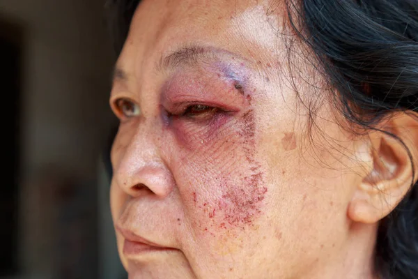 Elderly injury to the eyelid — Stock Photo, Image