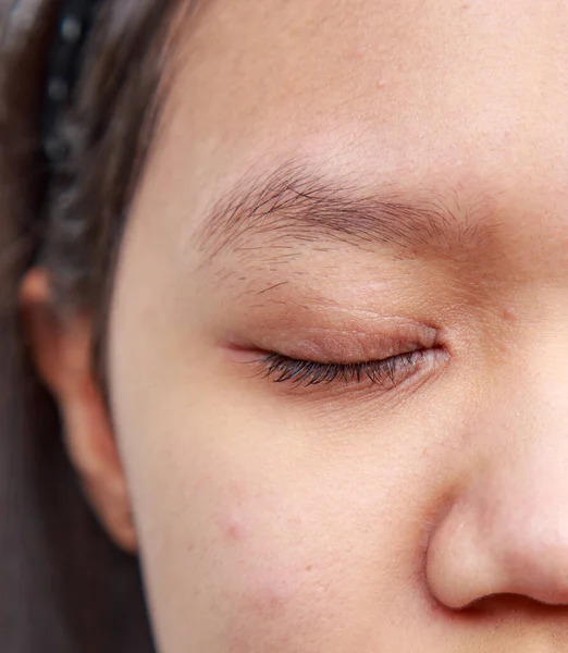 Problemas de la piel facial es acné y manchas . —  Fotos de Stock