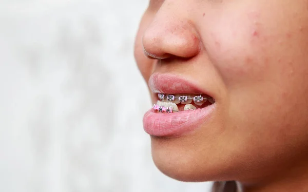 Zahnspangen zur Behandlung von Symptomen — Stockfoto
