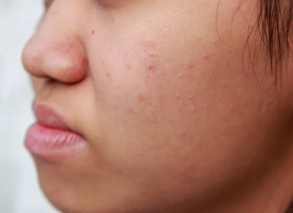 Problemas de la piel facial es acné y manchas . —  Fotos de Stock