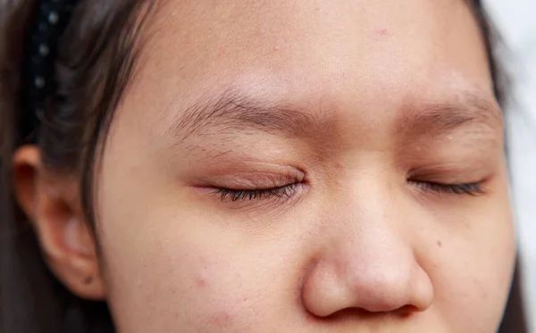 Problemas de la piel facial es acné y manchas . —  Fotos de Stock