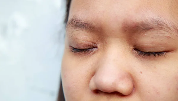 Problemas de la piel facial es acné y manchas . —  Fotos de Stock