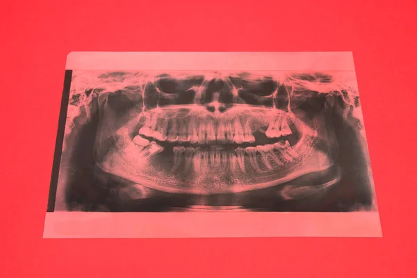 Panoramic x-ray image of teeth. Some teeth removed, problem with teeth on red background.