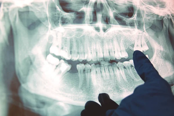 Imagen Panorámica Rayos Los Dientes Algunos Dientes Quitados Problema Con —  Fotos de Stock