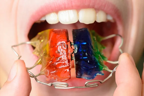 Close Mouth Crooked Teeth Braces Toothbrush Mouth Adolescent 2019 — Stock Photo, Image