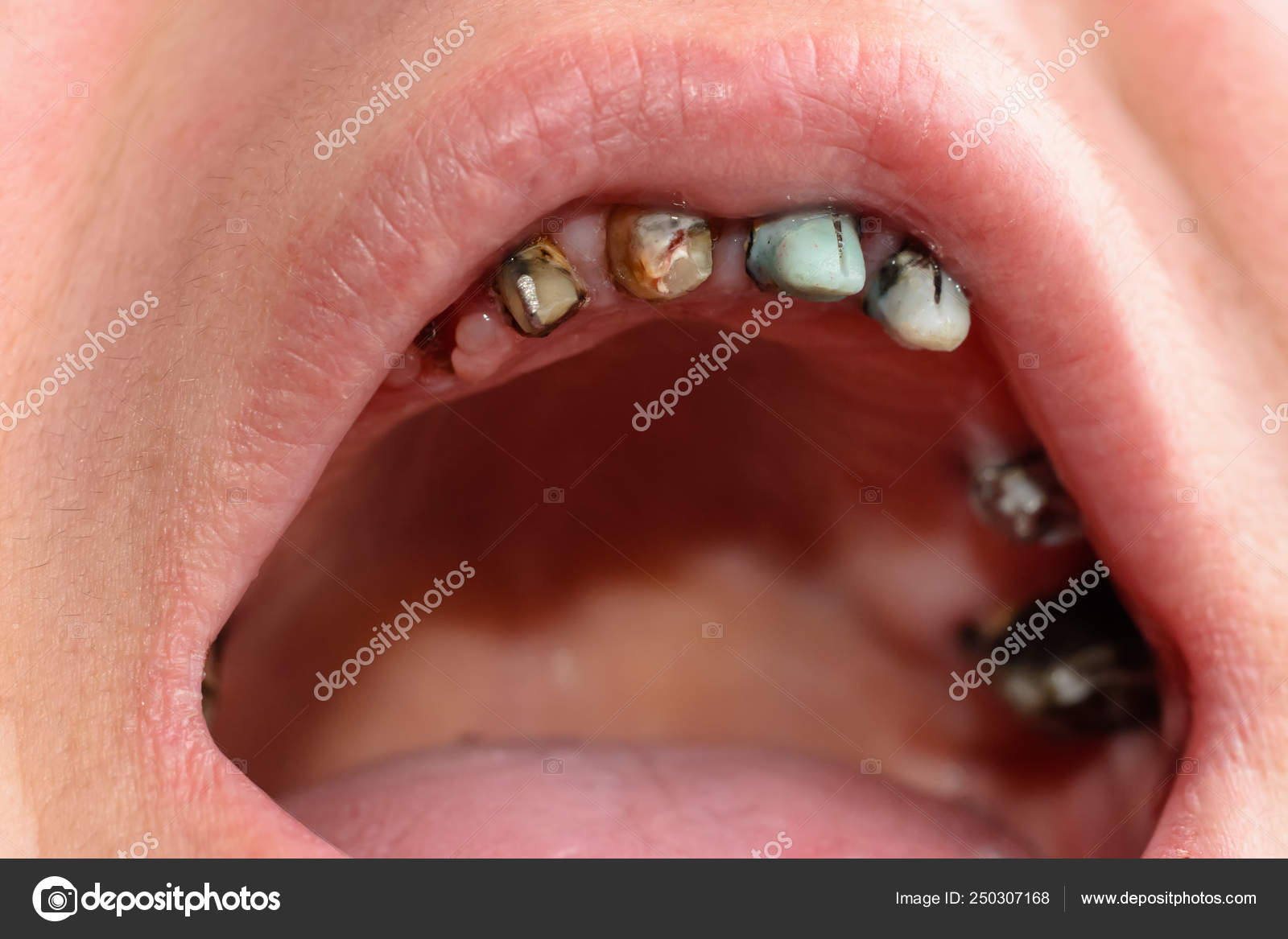 Featured image of post Dente Entramelado Succede non di rado che un dente del giudizio non riesca a spuntare correttamente e quando si verifica questa situazione si parla di dente incluso