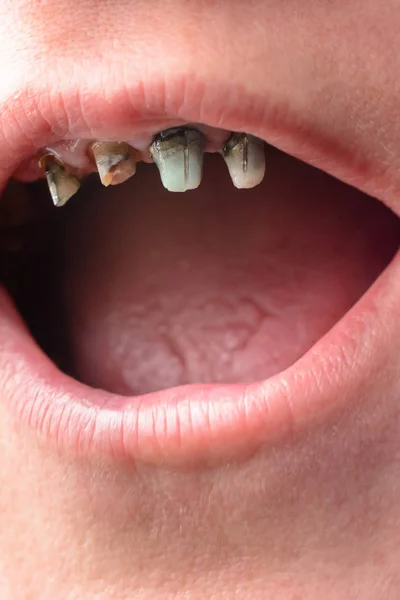 Η γυναίκα άνοιξε το στόμα της ευρείας, και της έδειξε στραβό και χαλασμένα δόντια, κοντινό πλάνο — Φωτογραφία Αρχείου