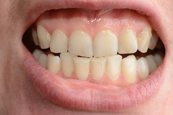 Una giovane donna mostra i suoi denti storti che hanno bisogno di aiuto medico in primi piani — Foto Stock