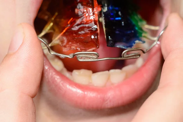 A big plan for dressing a metal plate for tooth bristling