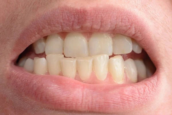 Młoda kobieta pokazuje jej krzywe zęby, które potrzebuje pomocy medycznej w zbliżeniach — Zdjęcie stockowe