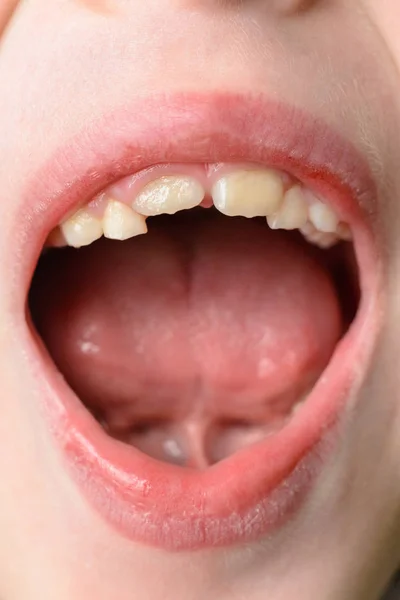 The child opens wide mouths, showing his crooked teeth after falling of milk teeth