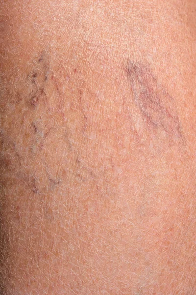 Nahaufnahme des Beines einer älteren Frau, die an Krampfadern erkrankt ist — Stockfoto