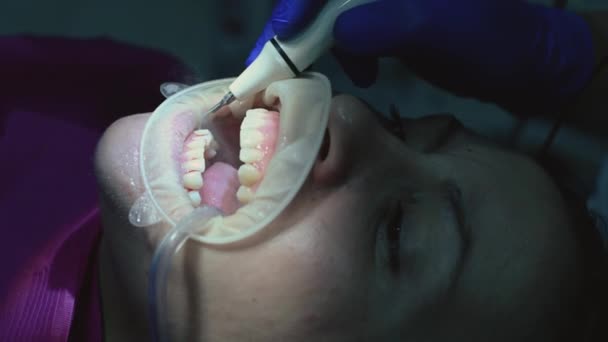 牙科医生处的病人 用超声波除去焦油 — 图库视频影像