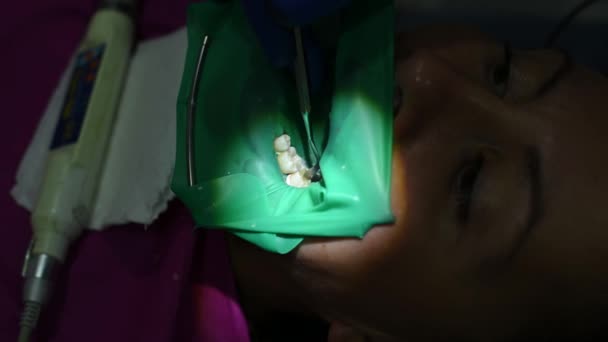 Zubař Tvoří Výplň Tvaru Zubu Ústní Dutina Pokryta Gumovou Přehradou — Stock video