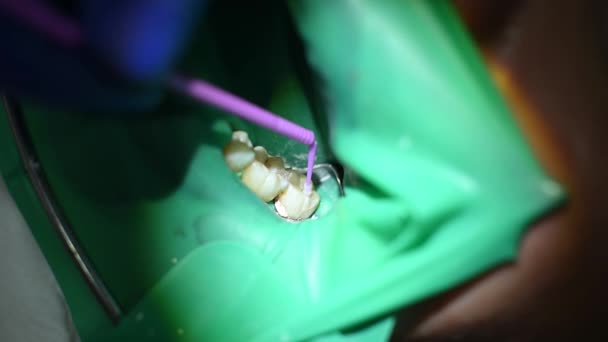 Der Zahnarzt Formt Eine Zahnförmige Füllung Die Mundhöhle Ist Mit — Stockvideo