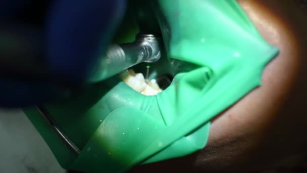 Лечение Наполнение Зуба Стоматолог Удаляет Сверло Заполнения Препятствует Укусу — стоковое видео