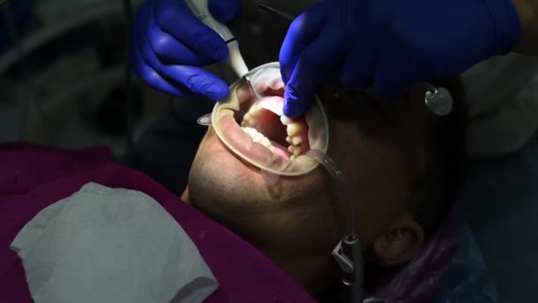 Dentysta Używa Ultradźwięków Usunąć Tatuaż Twardą Płytkę Zębach — Wideo stockowe