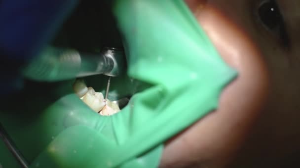Tratamiento Llenado Del Diente Dentista Retira Relleno Del Taladro Que — Vídeos de Stock