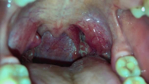 Angina, tonsillite purulenta, gola con pus sulle tonsille — Video Stock