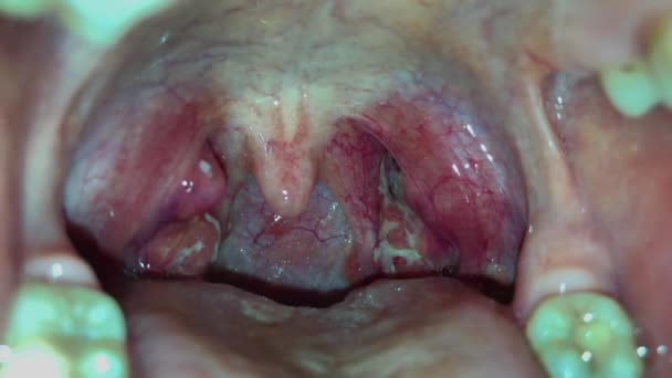 Angina, amigdalite purulenta, garganta com pus em amígdalas — Vídeo de Stock