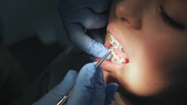 Montaj ve diş genç kız yakın çekim üzerinde metal parantez sabitleme.