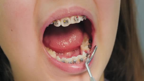 Examen de cerca de los dientes de una chica con aparatos ortopédicos — Vídeo de stock