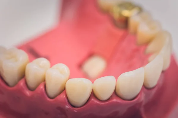 stock image Detailed close up of dental denture or teeth on a table, dentistry