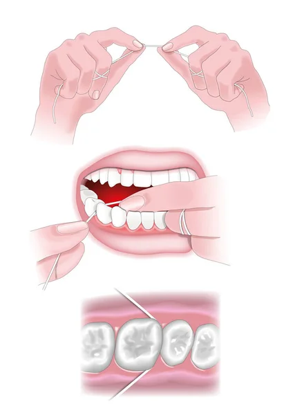 Zahnseide Wie Man Sie Verwendet Symbolelemente Befinden Sich Auf Einer — Stockvektor