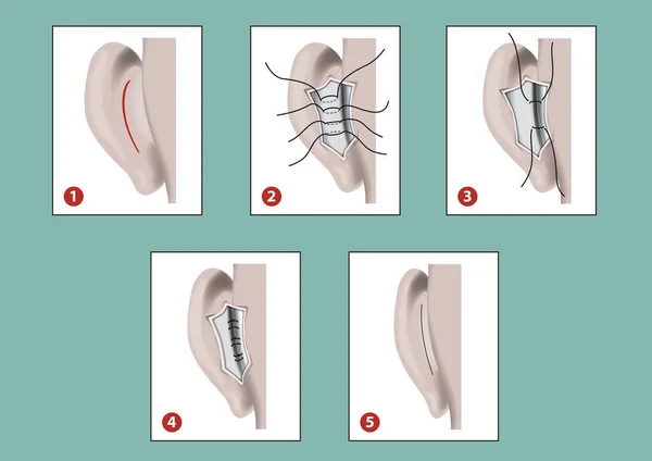 Esquema Esquemático Otoplastia Orejas Aleteando — Vector de stock