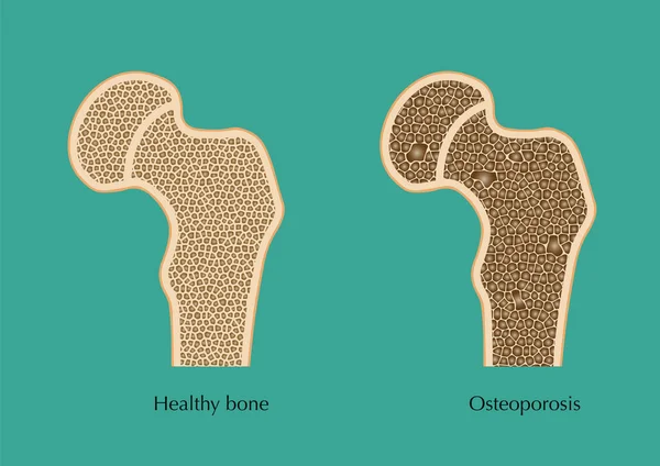 Normal femur ve osteoporoz şeması.. 