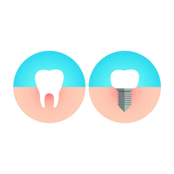 Dente humano e implante dentário. Ícone de ilustração vetorial simples plano . —  Vetores de Stock