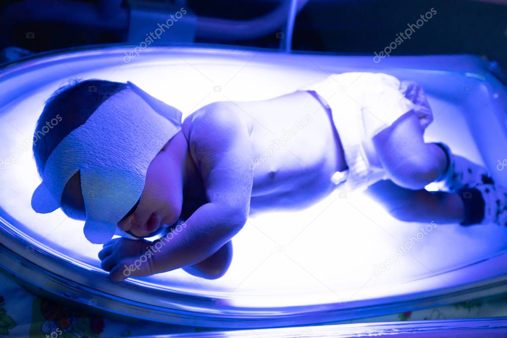 The baby lies under an ultraviolet lamp with jaundice