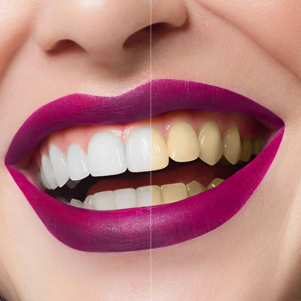 Healthy white smile close up. Beauty woman with perfect smile. Beautiful Model Girl with pink lips. Teeth whitening and cleaning, dental care. Whitening - bleaching treatment ,before and after