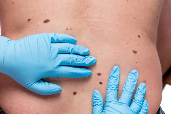 Dermatologist looking ar birthmark on patient — Stock Photo, Image