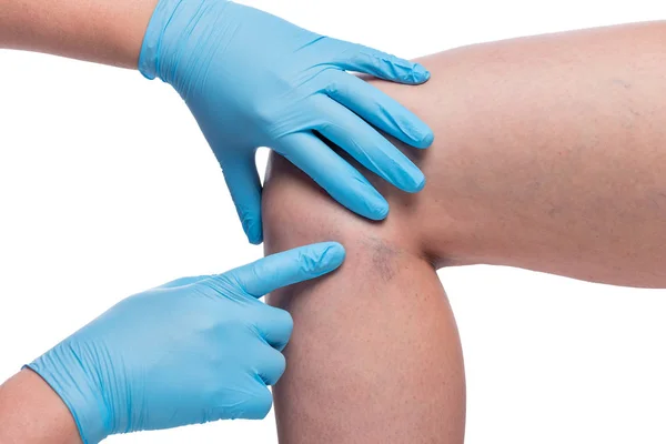 Mains du médecin examinent les varices sur la jambe féminine, vaisseaux cl — Photo