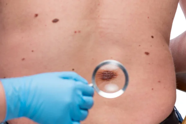 Dermatolog bir hastanın sırtındaki deriyi inceliyor. — Stok fotoğraf