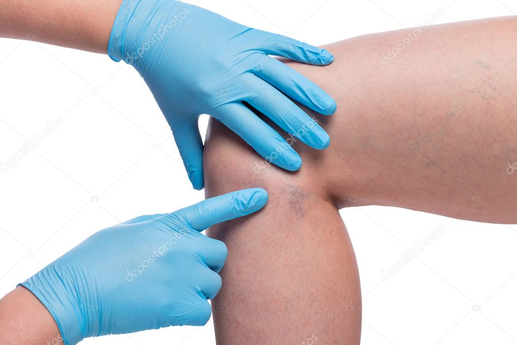 hands of doctor examine varicose veins on female leg, vessels cl