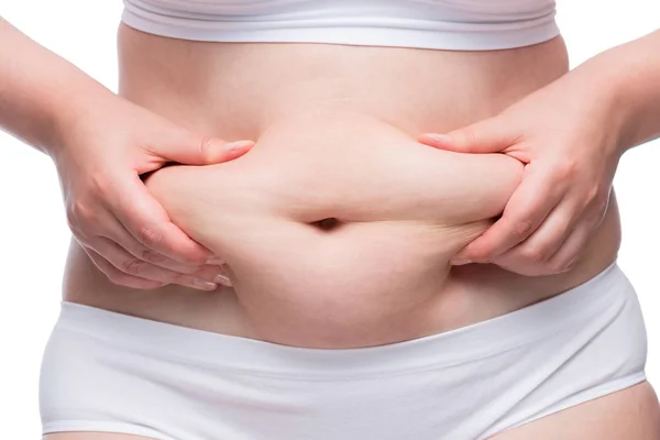 Frauenhände zerknüllen Fett auf einem dicken Bauch, Nahaufnahme unter — Stockfoto