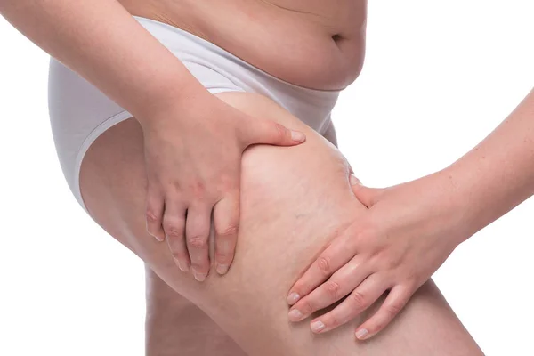 Celulitis en las piernas cerrar las manos exprimir la piel —  Fotos de Stock