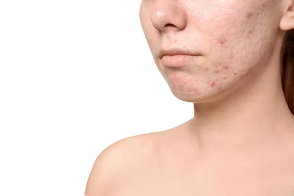 Jonge Vrouw Met Acne Probleem Witte Achtergrond — Stockfoto