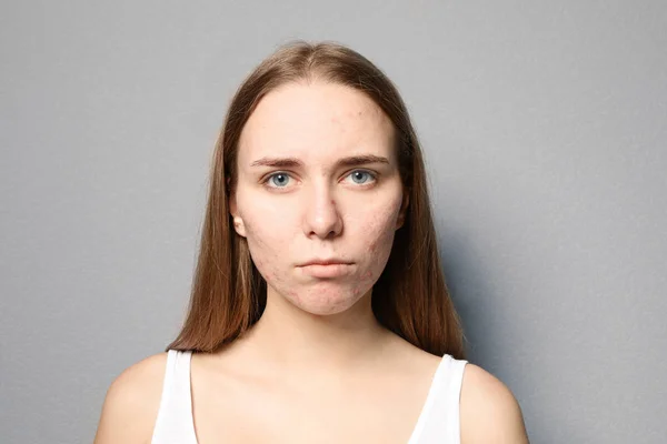 Junge Frau Mit Akne Problem Auf Farbigem Hintergrund — Stockfoto