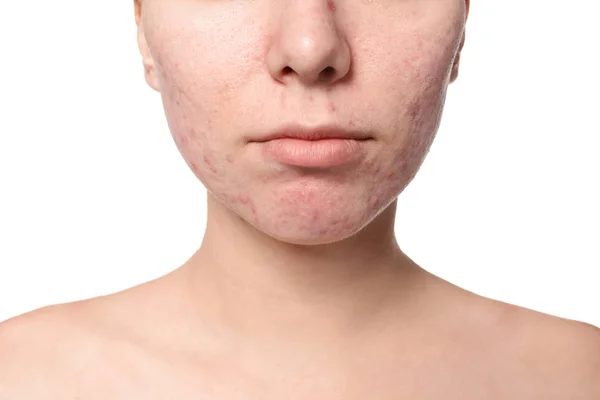 Jovem Com Problema Acne Fundo Branco — Fotografia de Stock