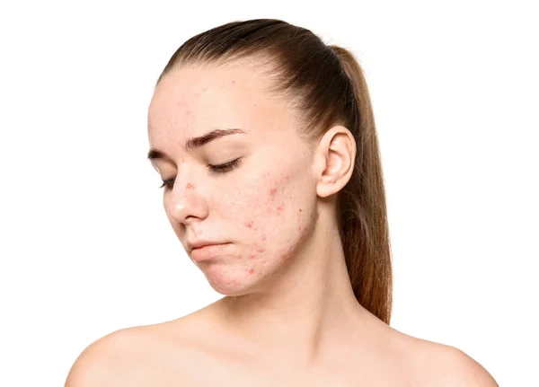 Jonge Vrouw Met Acne Probleem Witte Achtergrond — Stockfoto