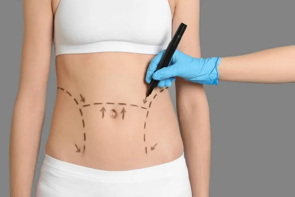 Arzt Zeichnet Markierungen Weiblichen Bauch Für Schönheitschirurgie Nahaufnahme — Stockfoto