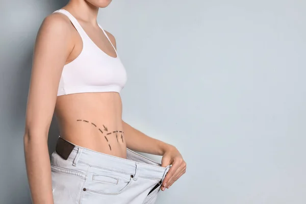 Mujer Joven Con Marcas Vientre Jeans Grandes Después Operación Cirugía —  Fotos de Stock